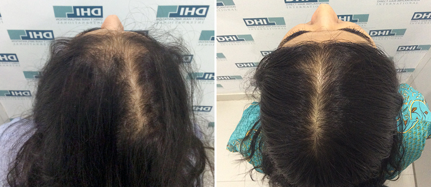 DHI before & after hair transplant results